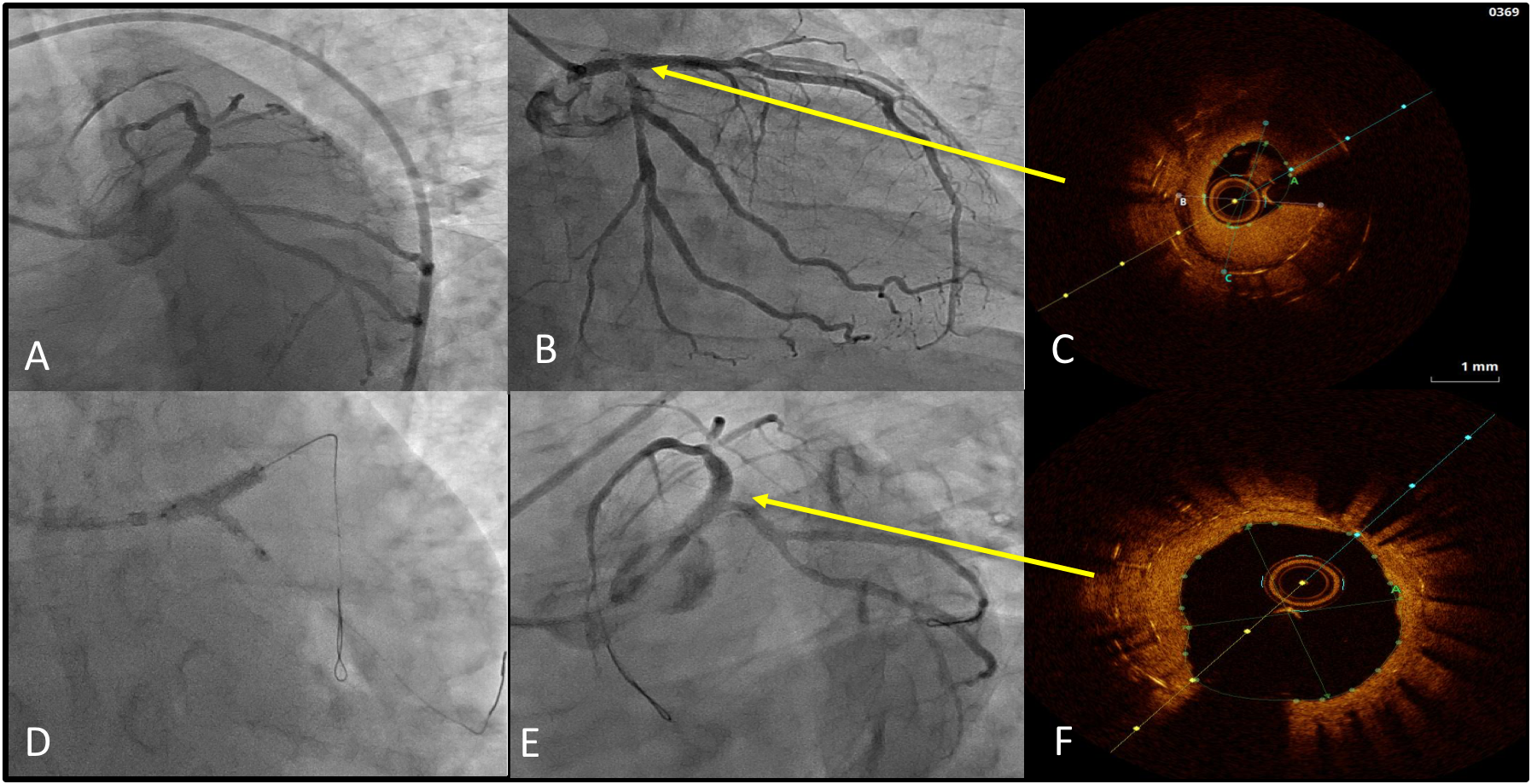 Left Main restenosis-publication of the review article in CRM